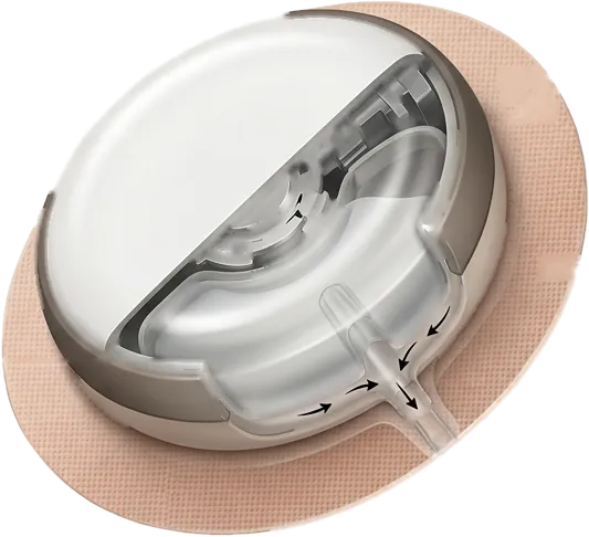 Cutaway illustration of the Pocket Clinic Wearable 7-Day Smart Injector on its adhesive patch